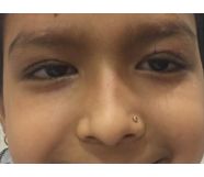 Ptosis After- Dr Anita Sethi