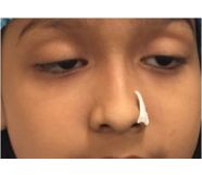 ptosis before - Dr Anita Sethi